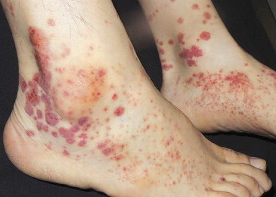 геморрагии