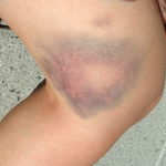 Высыпания при лейкозе