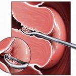 Причины обильных месячных после выскабливания